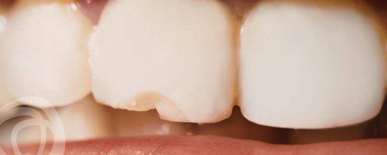 Medland Chipped Tooth Brisbane